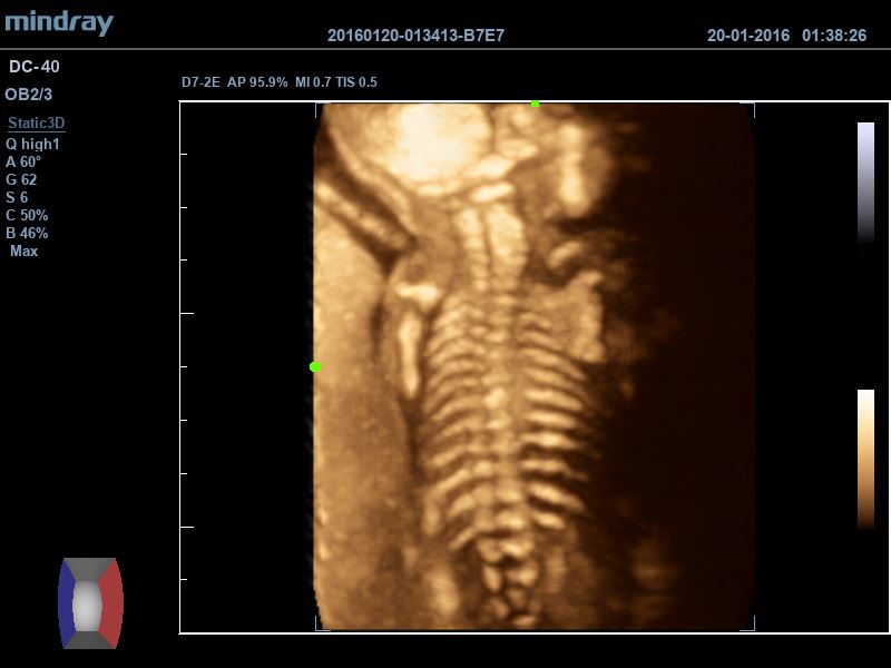 3D Fetal Spine