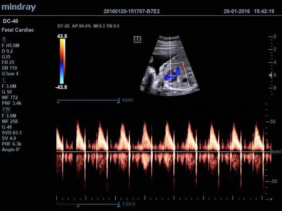 Pulse Wave of Fetal Heart